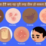 soriasis-kya-hai-kya-yeh-poori-tarah-thik-ho-sakta-hai