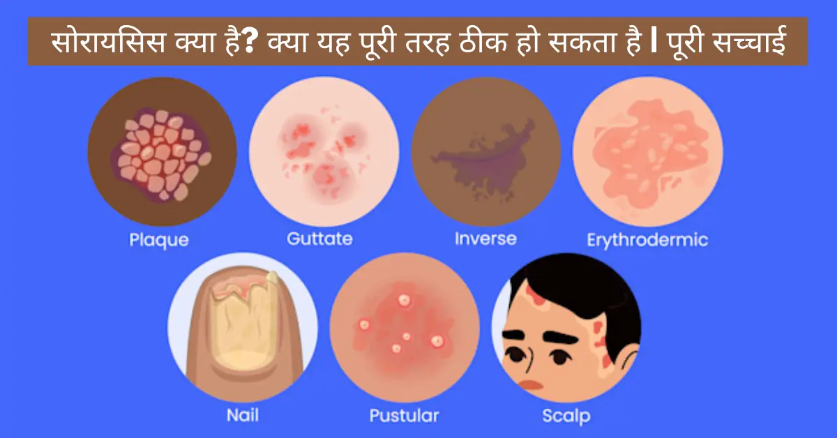 soriasis-kya-hai-kya-yeh-poori-tarah-thik-ho-sakta-hai